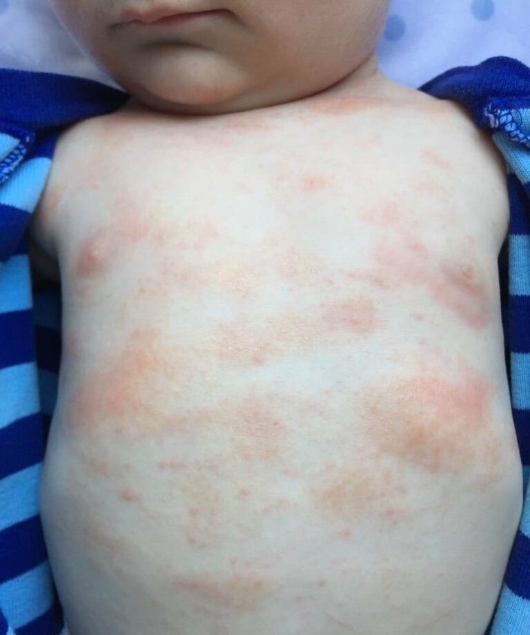 The Leaky Gut and Eczema Connection Is Western Medicine Finally