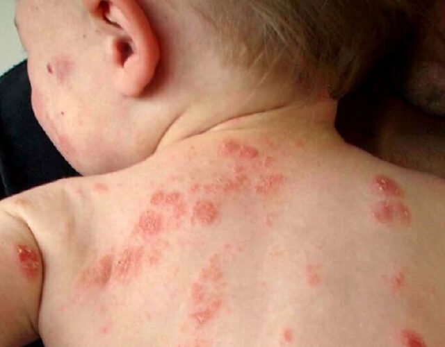 eczema