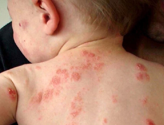 eczema