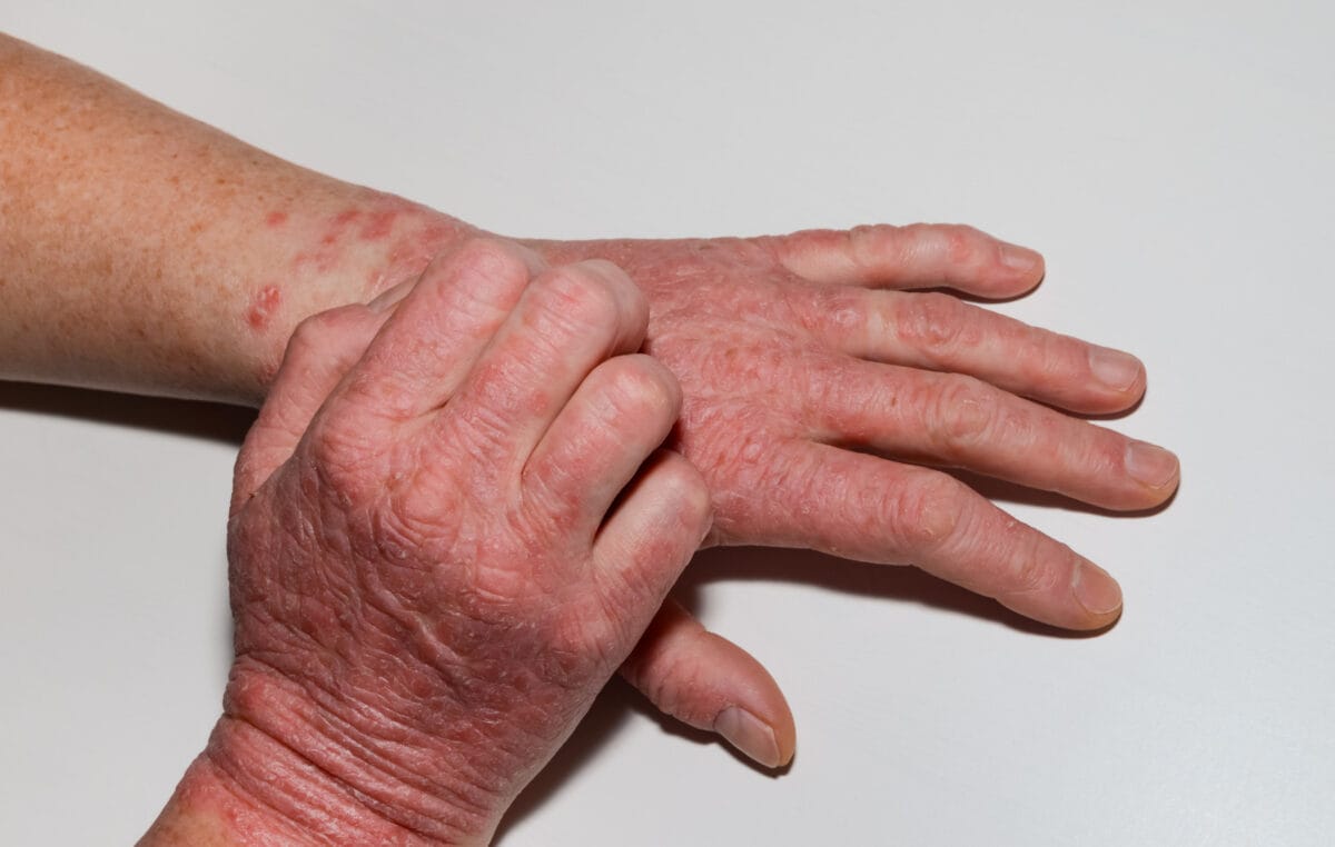 Natural Ways To Deal With Eczema On Hands