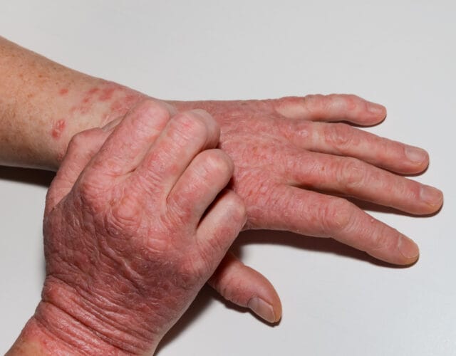 Natural Ways To Deal With Eczema On Hands