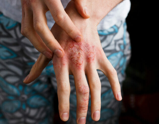Closeup men itching and scratching by hand. Psoriasis or eczema on the hand. Atopic allergy skin with red spots
