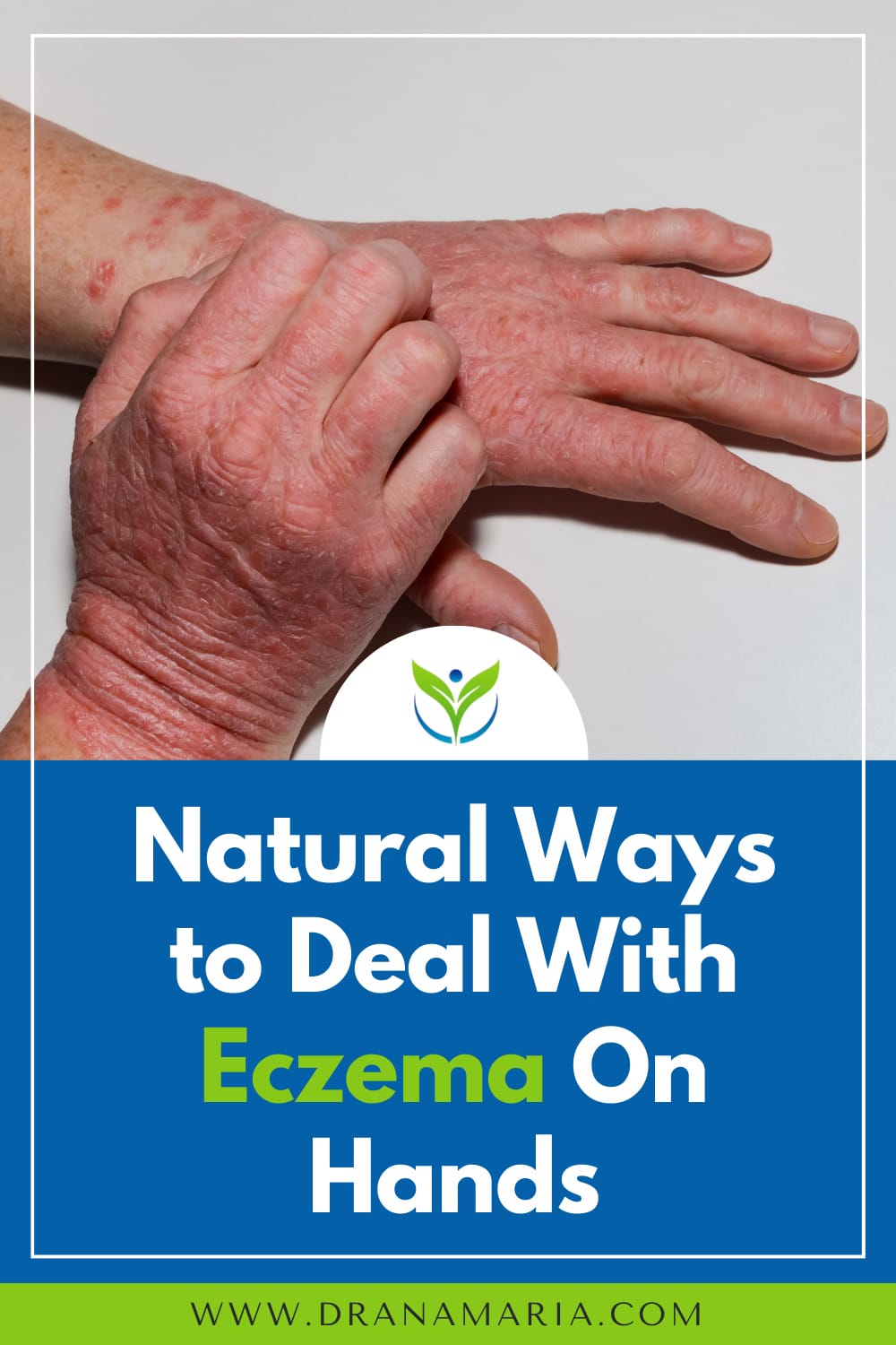 Natural Ways To Deal With Eczema On Hands