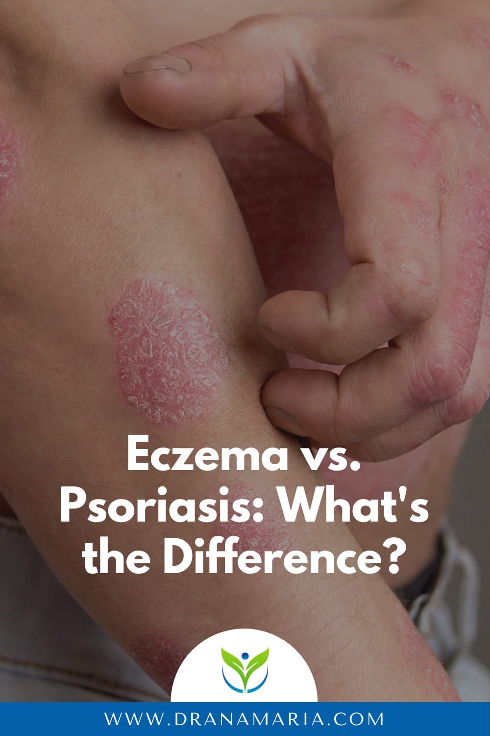 Eczema Vs. Psoriasis What's The Difference