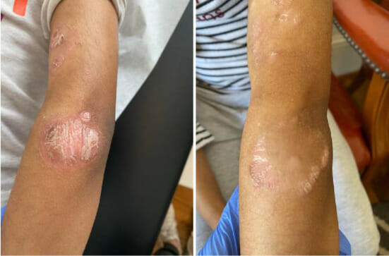 Eczema vs. Psoriasis: What's the Difference?