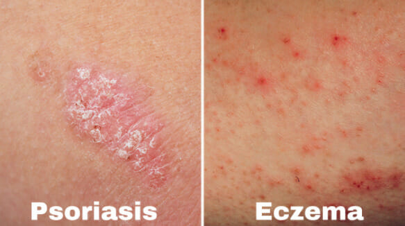 Eczema vs. Psoriasis: What's the Difference?