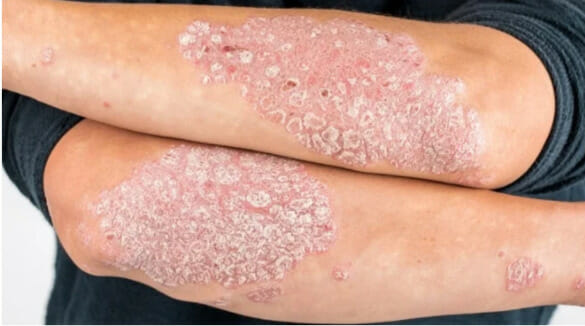 Eczema vs. Psoriasis: What's the Difference?