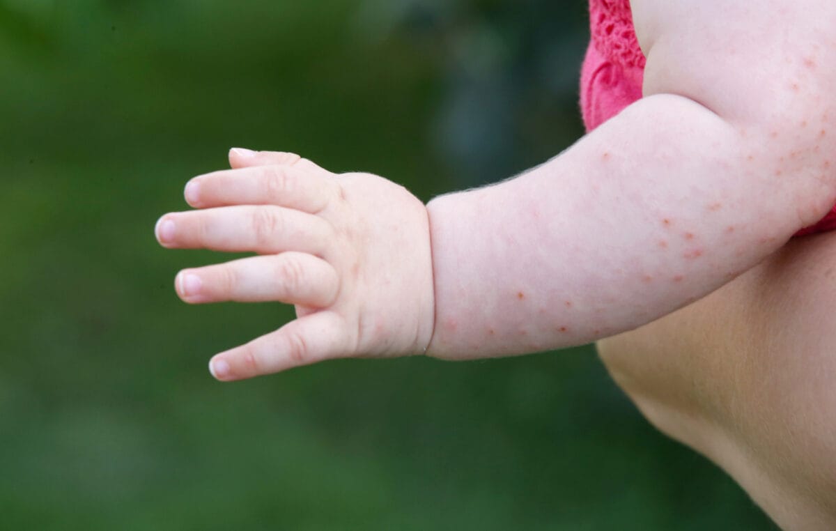 Eczema And Allergy In Kids Integrative Health