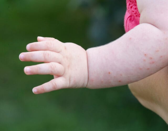 Eczema And Allergy In Kids Integrative Health