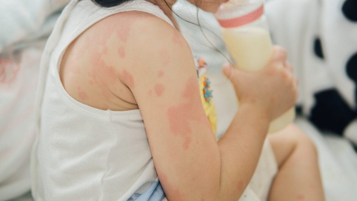 what causes eczema