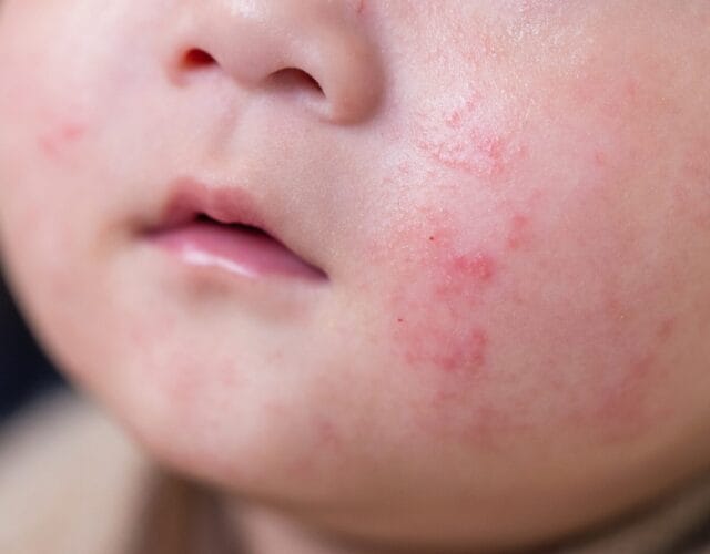 Up close picture of baby with Eczema on cheeks