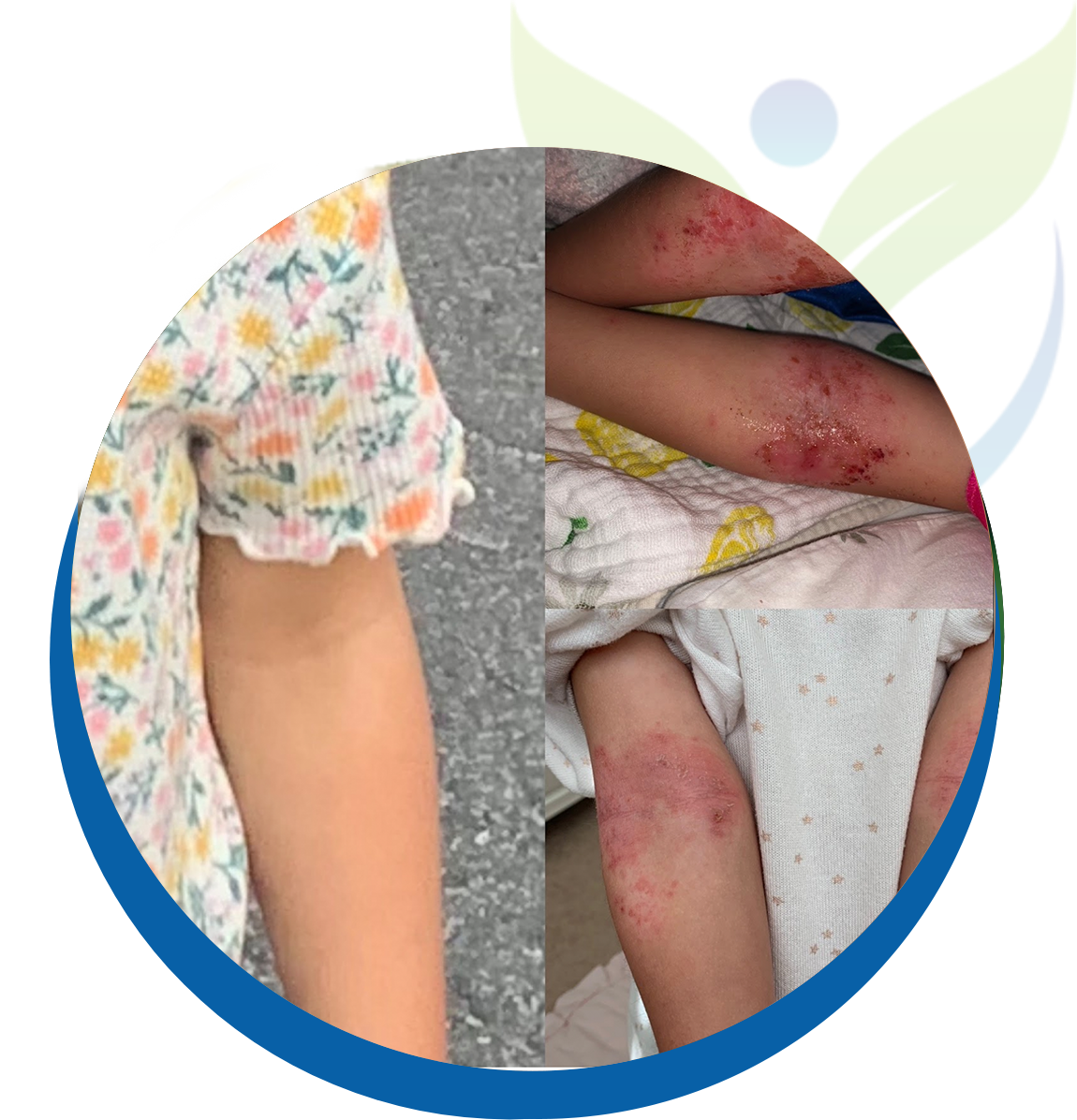 Before and after of child suffering from Eczema